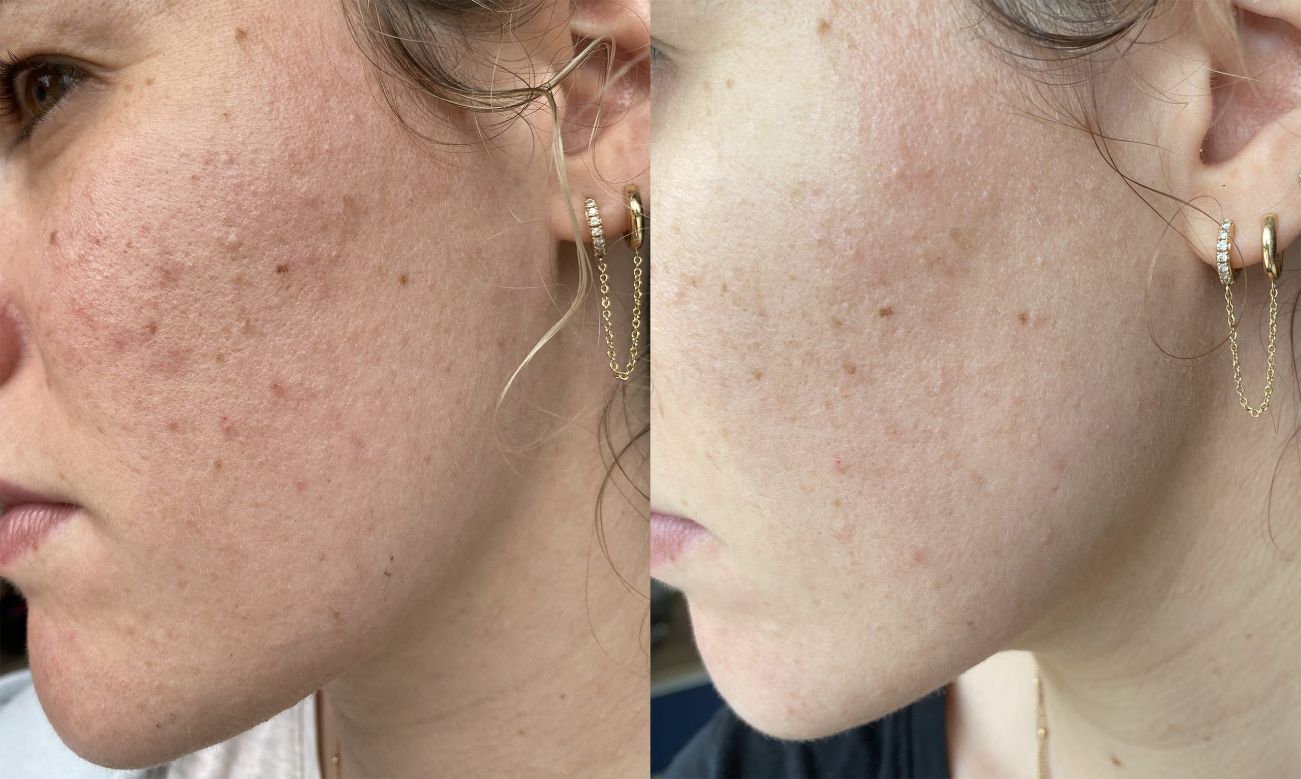 avant-apres-5-seances-microneedling-brest