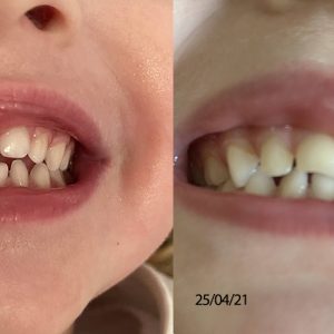 avant-apres-machouyou-avis-ok2